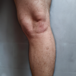 Tratamientos para eliminar grasa en la parte interna de la rodilla